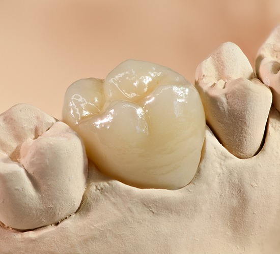 dental crown example