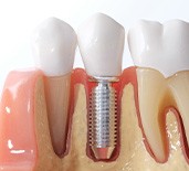 Osseointegration is when your dental implant fuses with your jawbone