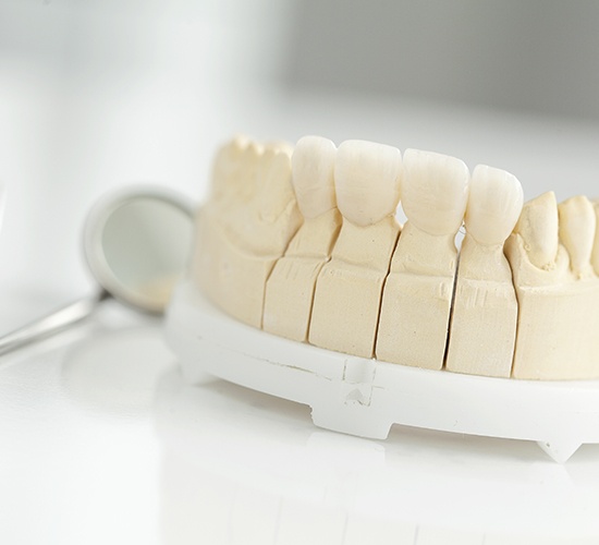 four piece dental bridge