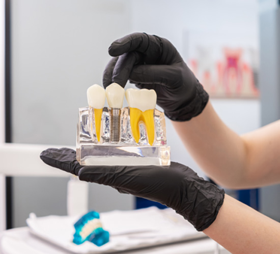 Dentist with black gloves holding model of dental implant