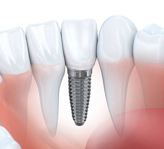 dental implant with crown replacing missing tooth 