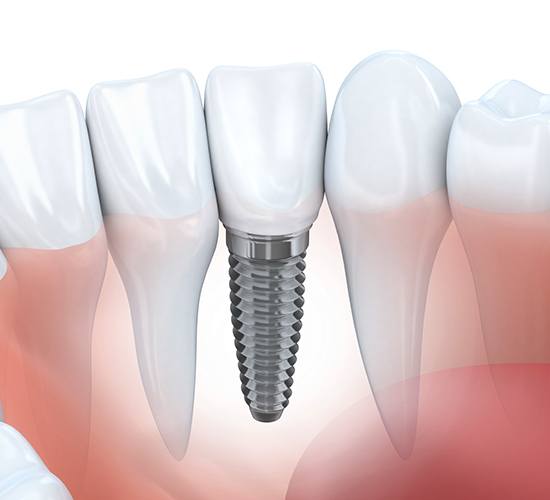 computer illustration of implant between teeth