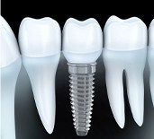 single implant