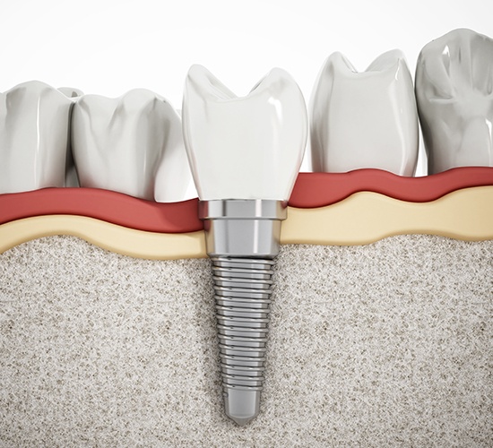 computer illustration of dental implant