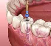Illustration of root canal treatment being performed on tooth in lower arch