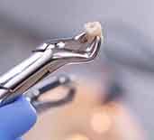 Close-up of forceps holding an extracted tooth
