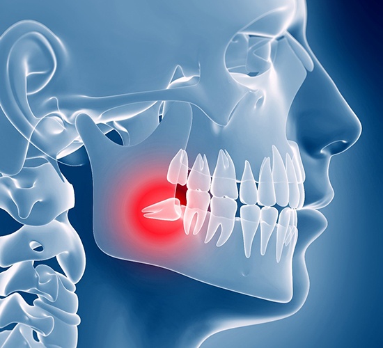 X-ray showing an impacted wisdom tooth 