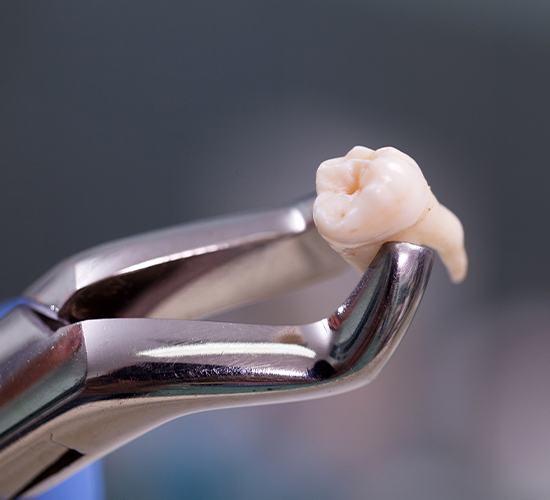 extracted wisdom tooth in metal clamp