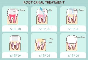 Root canal therapy in Rockledge restores a failing tooth to full health. Drs. NIchols or Collins of Premiere Walk-in Dental can determine when you need it.