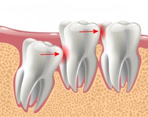 impacted wisdom teeth 