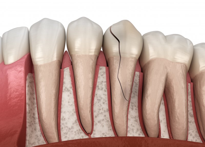 3D render of a fractured tooth