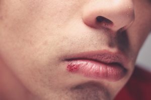 person with a cold sore on their lip
