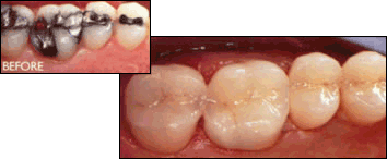 tooth-colored fillings