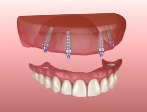 Model of upper implant denture